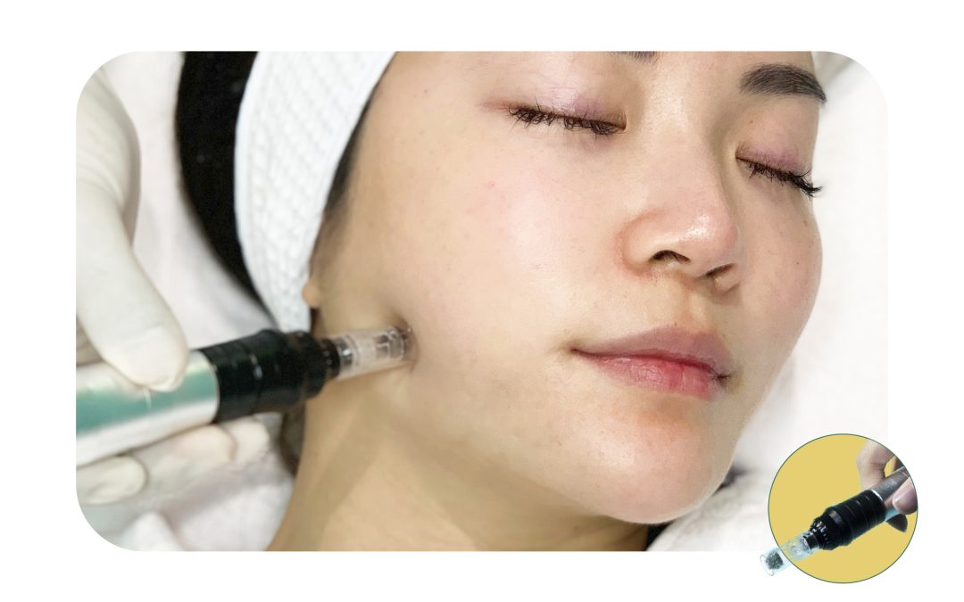 Derma Pen